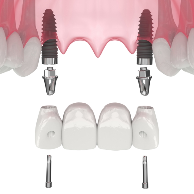 Implant dentaire